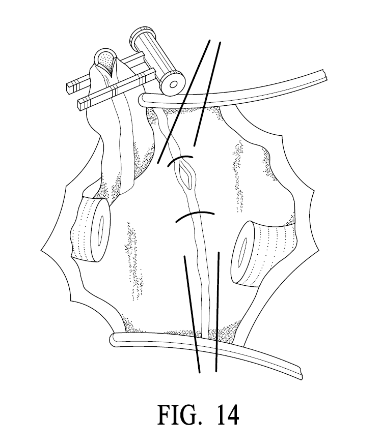 A professional utility patent drawing demonstrating open heart surgery for USPTO submission.